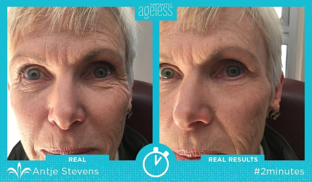 Instantly Ageless Facelift